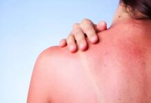 Έγκαυμα από ήλιο: Τα σωστά βήματα για θεραπεία και ανακούφιση