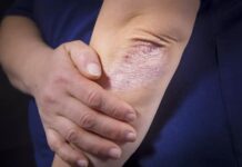 Κρούσματα Ψώρας σε Γυμνάσιο της Θεσσαλονίκης – Άμεση Κινητοποίηση και Απολύμανση